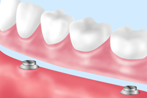 インプラントオーバーデンチャー