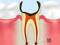 C4：歯根まで達した虫歯