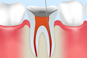 重度の虫歯の治療――「根管治療」