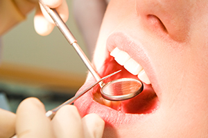 生涯を通じて健康な歯でいるための「予防処置」を活用しましょう